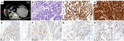 Relapsed and refractory yolk sac tumor of the peritoneum (mesentery): A case report and literature review